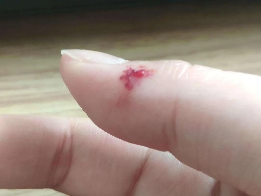 求解梦见老鼠咬我手指还出了血急急急