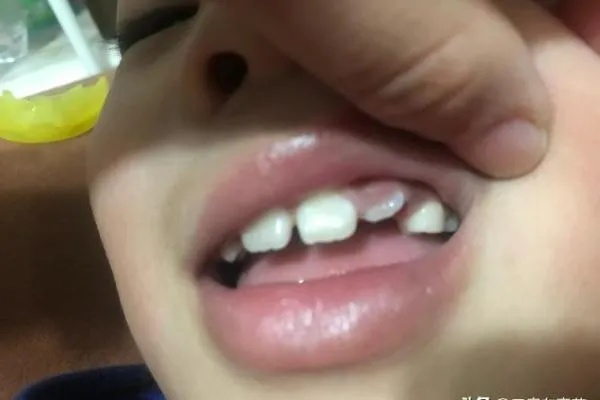 梦见儿子掉了两个牙齿，梦境背后的深层含义与解析