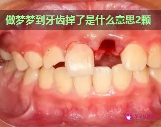 梦境解析，下午做梦见掉了六颗牙没有流血
