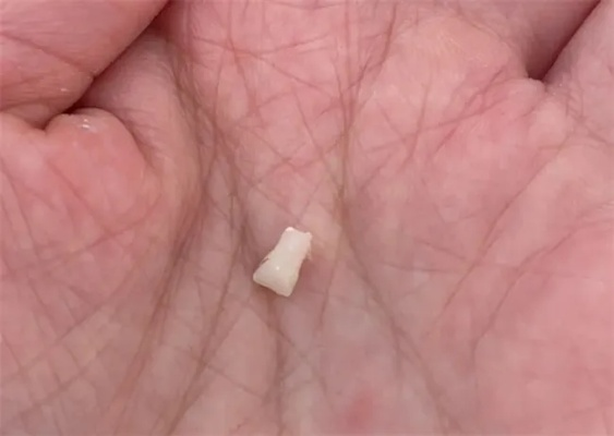解析梦境，梦到牙齿碎了——有懂解梦的朋友来帮忙解释