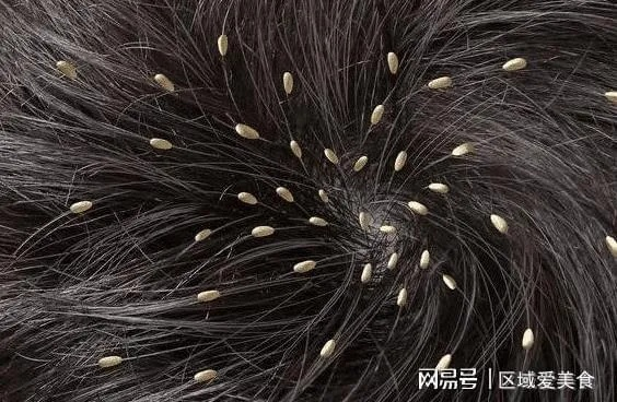 周公解梦，梦见在自已头上摸到虱子，暗示了什么？