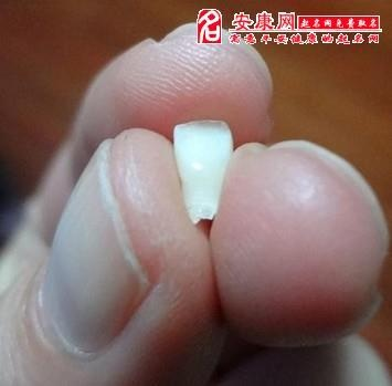 梦见下牙掉了四颗还流了血，解析梦境背后的深层含义
