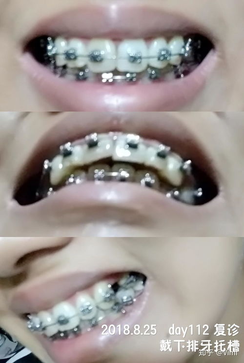 梦见自己补的牙齿碎了是上门牙，解析梦境背后的深层含义