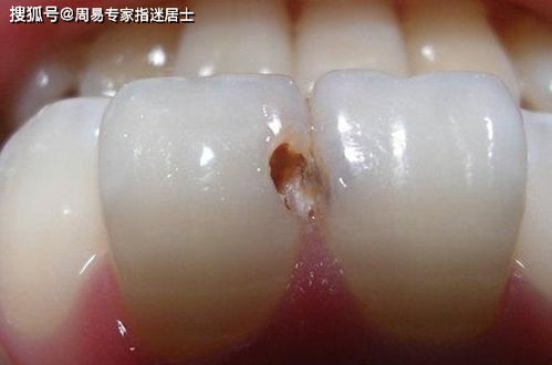 昨晚梦见自己掉牙了，这究竟预示着什么？