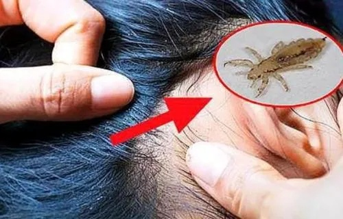梦境与现实，晚上梦见自己长虱子，是否预示着生活中的某种变化？