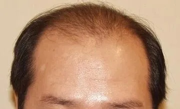 揭秘梦境，为何会梦见自己变成秃顶？