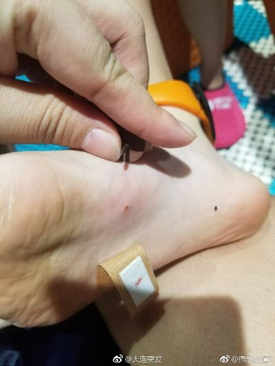 梦境的警示，梦见小孩脚趾被钉子穿透的深层解析