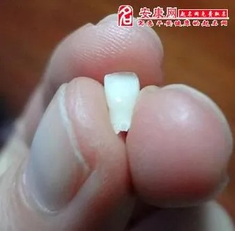 解梦，大门牙掉落之梦——探寻潜意识中的暗语与启示