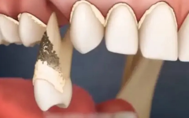 解析梦境，大牙掉落一半——上排牙左边的预兆与解读