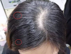 解析梦境，梦见头发脱落与脓包滋生的深层含义