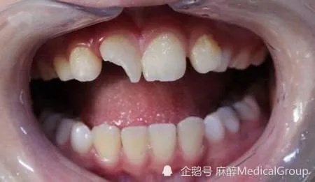 梦境中的重生，解析夜里梦到牙齿掉落，无痛却流血，随后长出小牙的深层含义