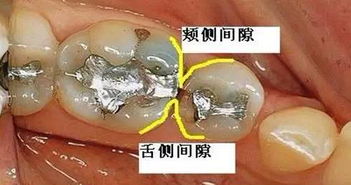 梦见牙齿掉光了自己按上去，探索梦境背后的深层含义