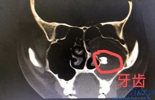 梦见头上和鼻子被打流血，探索梦境背后的深层含义