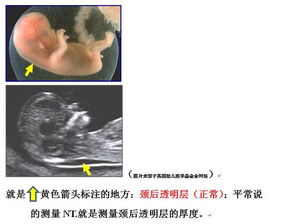 怀孕初期出血与梦境交织，探索心理与生理的微妙联系