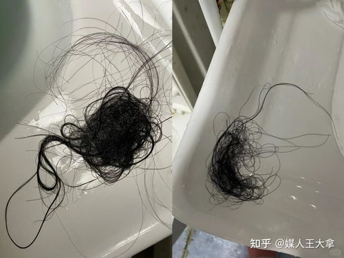 梦见自己的头发一大把一大把的掉下来意味着什么