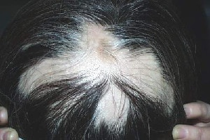 梦见自己掉头发秃了一点，探索梦境背后的深层预告