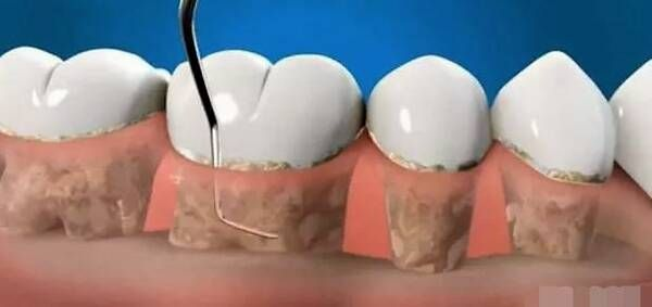 梦境解析，刷牙刷掉牙结石的深层含义