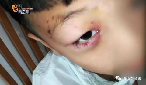 梦境解析，梦到被得狂犬病的狗咬脚底板——无出血的深深牙印与梦中的行走