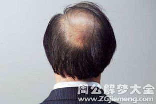 梦境解析，梦见自己头发一把一把地掉，意味着什么？