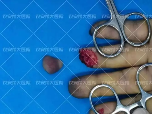 梦见手指断了一节，梦境背后的深层解析与心理启示