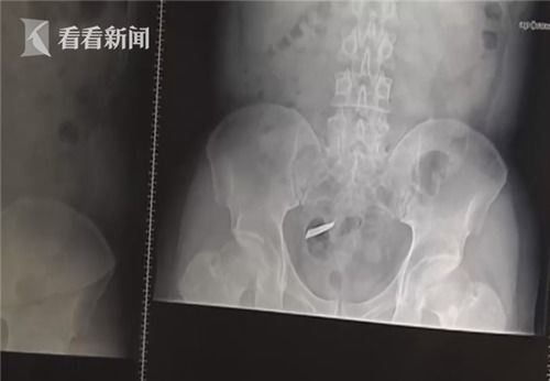 梦中梦，肚子疼与肝脏的隐喻
