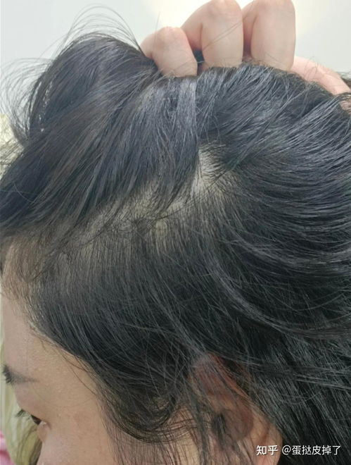 梦见头发脱落剃成光头，探索梦境背后的深层预兆与心理解析