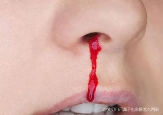 孕妇梦见自己流鼻血，梦境背后的深层含义与预兆解析