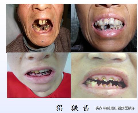 梦境解析，牙齿脱落的预兆与心理解析