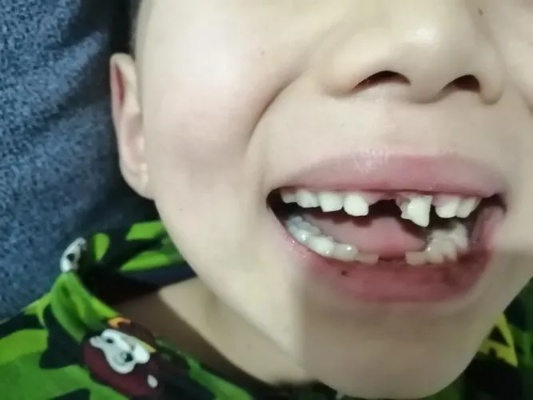 梦见掉了很多上牙下边还长了两排四颗新牙，探索梦境中的重生与转变