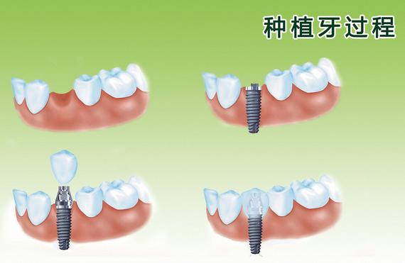 梦境解析，梦见右侧上方牙齿脱落的深层含义