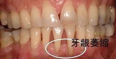 梦境解析，梦见牙齿脱落的深层含义