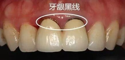 梦境解析，为何会梦到自己的牙齿全部掉光？