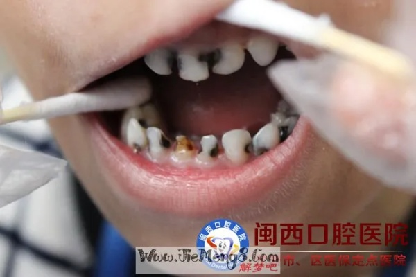 梦见下牙齿将掉下来但最终用手摇了摇后出了血还是没有掉