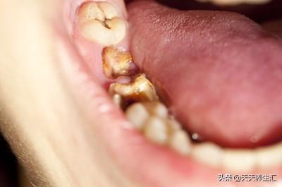孕妇梦见拔牙，梦境背后的深层含义与预示