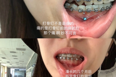 梦见牙齿掉光，梦境背后的深层含义与心理解析