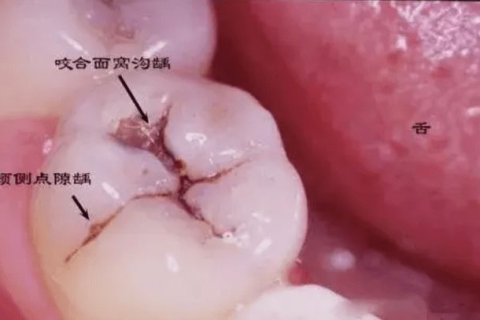 梦见牙齿掉了，后槽牙还在，前面要长新牙齿了，探索梦境中的转变与再生