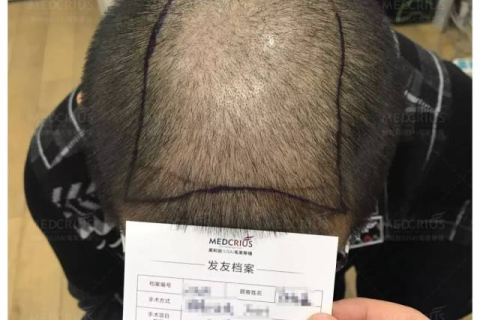 梦见自己掉头发，梦境背后的深层含义与潜在预兆
