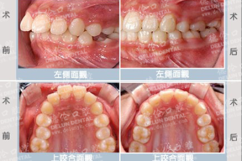 梦见牙齿都掉了，探索梦境背后的深层含义与心理解析