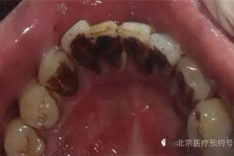 梦见牙齿脱落出血，梦境背后的深层含义与解析