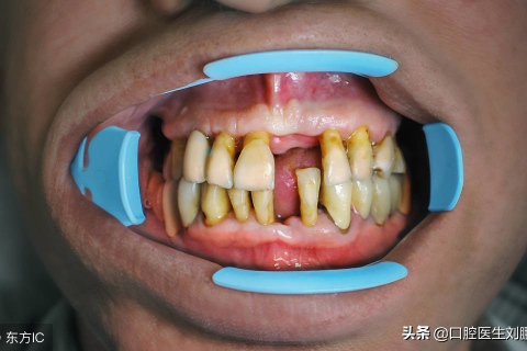 梦境解析，怀孕初期梦见牙齿脱落的象征意义与心理解析
