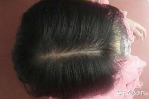 梦见自己头发掉光，解梦与心理分析