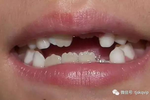 梦见掉两颗门牙又长出新牙，寓意新生与转变的梦境解析