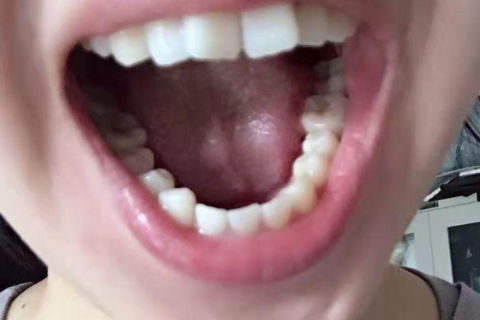 昨晚梦见门牙坏了后来牙全掉了，梦境背后的深层含义与心理解析