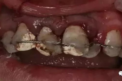 一直梦见掉四颗牙？高手帮你解读梦境背后的深层含义