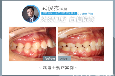 梦见掉了颗上牙，解读梦境背后的深层含义与心理暗示