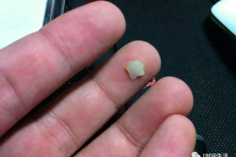 白天小碰撞与夜晚梦境的奇妙交织，牙齿脱落的预兆与解析