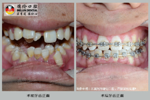 为什么我经常梦见自己牙齿掉了？探索梦境背后的深层含义与心理解析