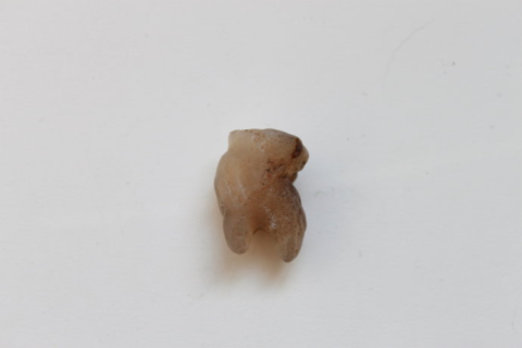 梦见下面的牙齿掉了，解读梦境中的深层含义与心理暗示
