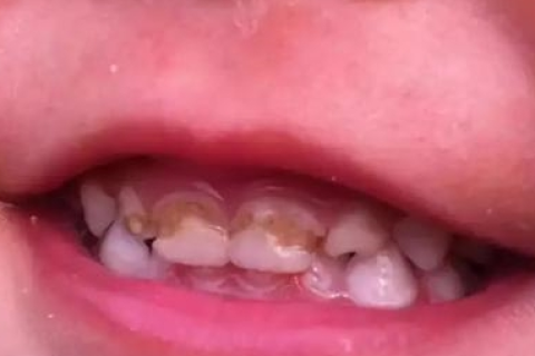梦见自己全口牙齿掉了又有乳牙，探索梦境背后的深层含义