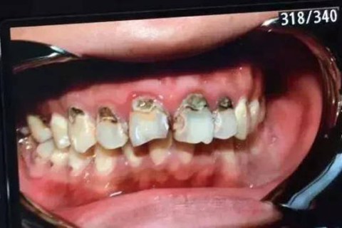 梦见掉牙我却还很高兴，探索梦境背后的深层含义
